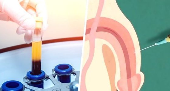 Male Sho.t Treatment