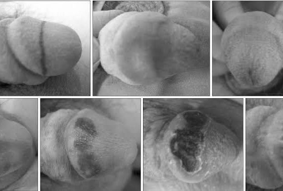 Hyaluronic Acid Glans Penise Enhancement Side Effects