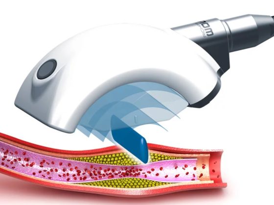 What is ESWT? Treatment in Istanbul/ Turkey